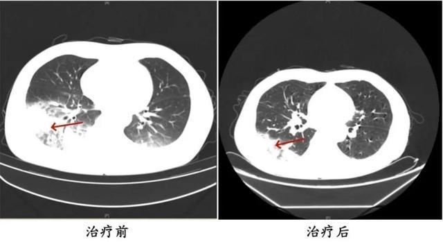 吹了3天空调，男子左肺“白”了一半！专家紧急提醒