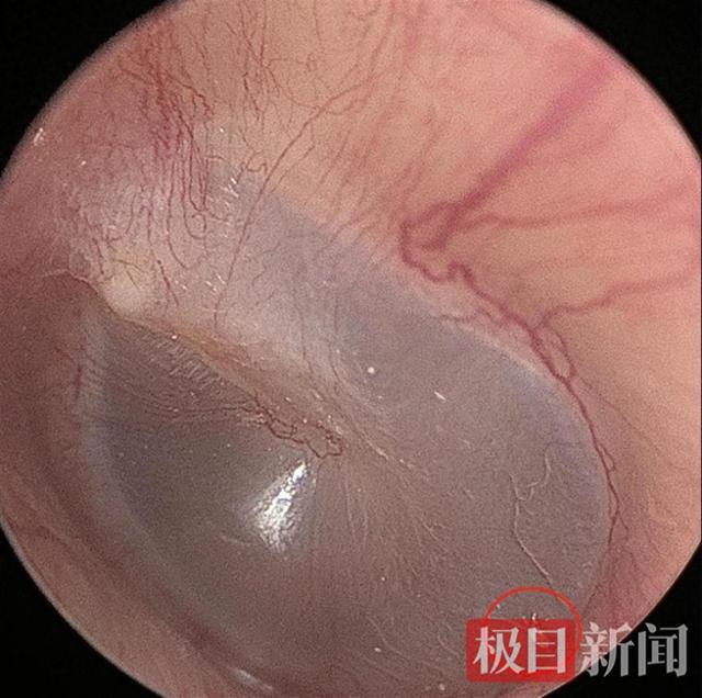 男子和猫同睡耳中长出猫螨虫:米粒大小正在鼓膜上爬行
