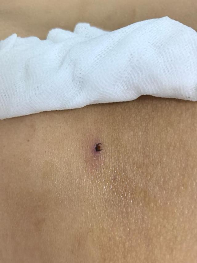 长沙男子右腰“长”出黑点，原以为旧疾复发，就医后被告知竟是一只虫……