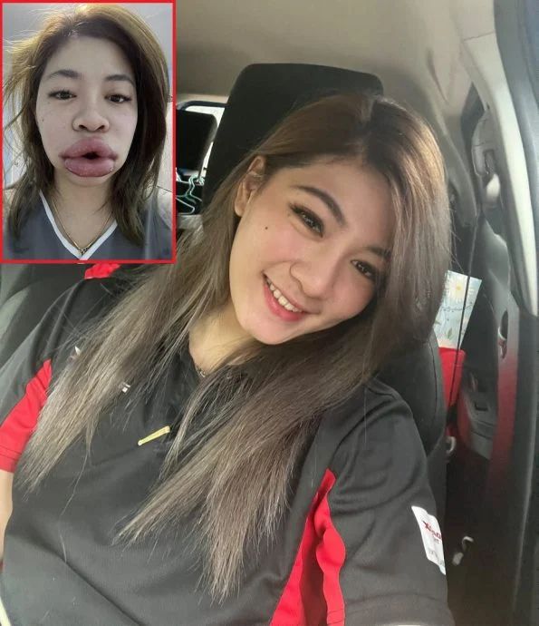 美了还要更美，泰国女子注射玻尿酸，唇肿如香肠