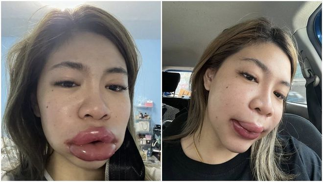 美了还要更美，泰国女子注射玻尿酸，唇肿如香肠