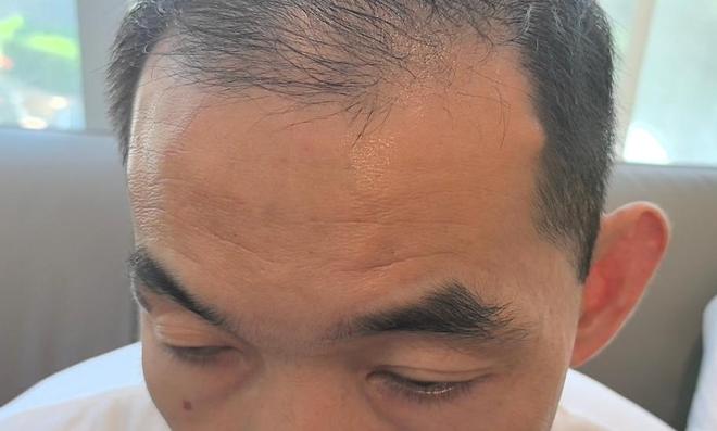 晨意帮忙丨男子花4千多去抬头纹次日感觉没效果想退款，医美机构：有恢复期，退三千
