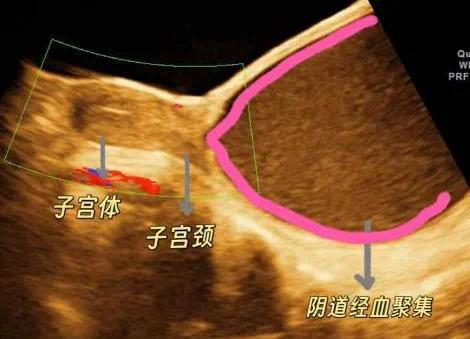 14岁女孩下腹不适且排尿困难，检查发现竟是处女膜闭锁“拦住”月经所致！
