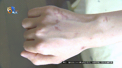 穿搭博主洗完澡后，浴室玻璃炸了！当事人：全身不知道缝了多少针