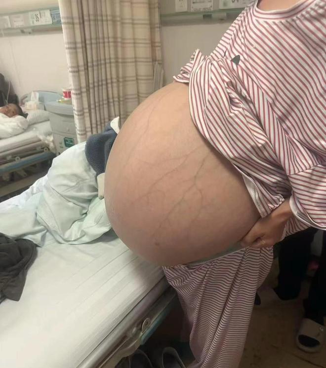 湖南“惊现”全国最大肿瘤！女子看似双胞胎孕妇，实则腹内长着38斤重的肿瘤……