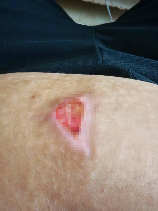 晨意帮忙丨女子做艾灸腹部被烫伤，美容店称系员工个人行为，记者介入后5员工赔1万2