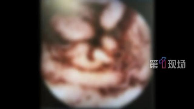 明星同款“彩椒碗”爆火，女子吃出“肠道吸血鬼”，医生提醒