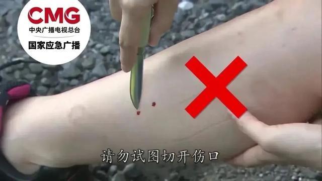 一男子踩到打架的竹叶青和五步蛇，被俩毒蛇咬3口，还对抗毒血清过敏…