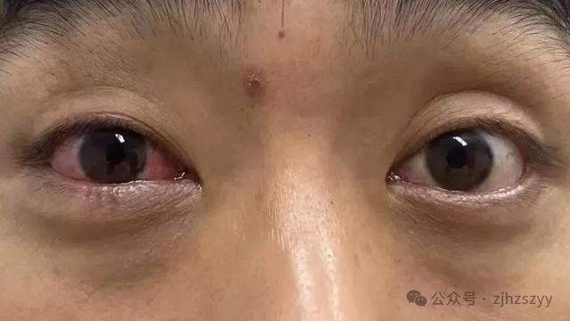 男子遇五步蛇想抓来玩 被喷一脸毒：引起化学性眼损伤