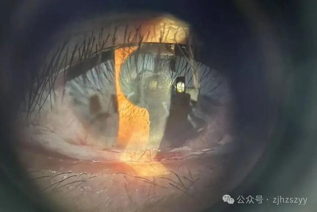男子遇五步蛇想抓来玩 被喷一脸毒：引起化学性眼损伤