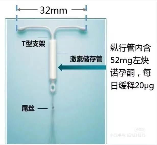 曼月乐总脱落？北京这项“免缝合”专利技术让曼月乐稳如泰山